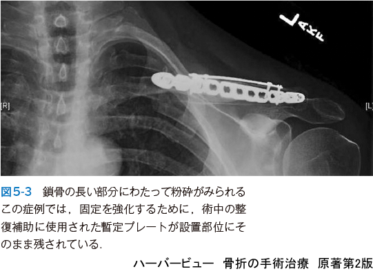 裁断済ハーバービュー 骨折の手術治療 【裁断済】ハーバービュー 骨折