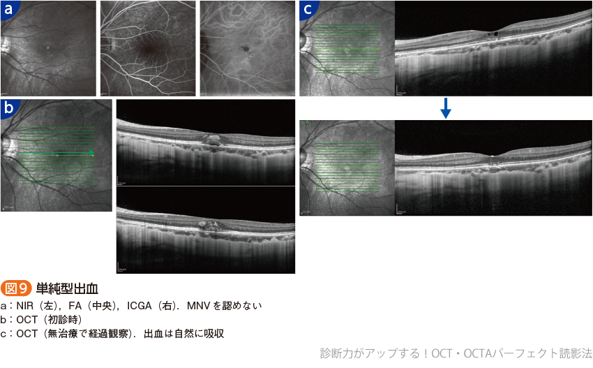 診断力がアップする！OCT・OCTAパーフェクト読影法〜正常・異常所見の