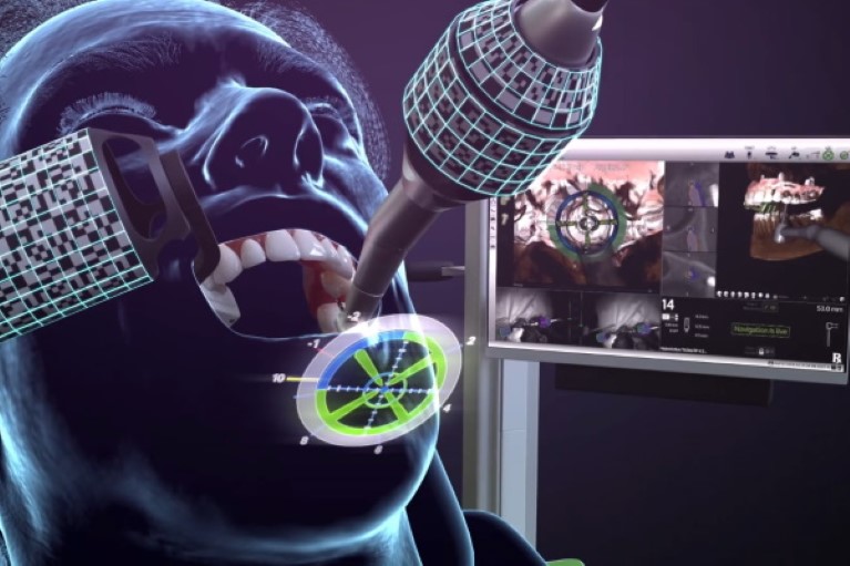 X-Guideを使用したインプラント手術｜天王寺区の横田歯科医院