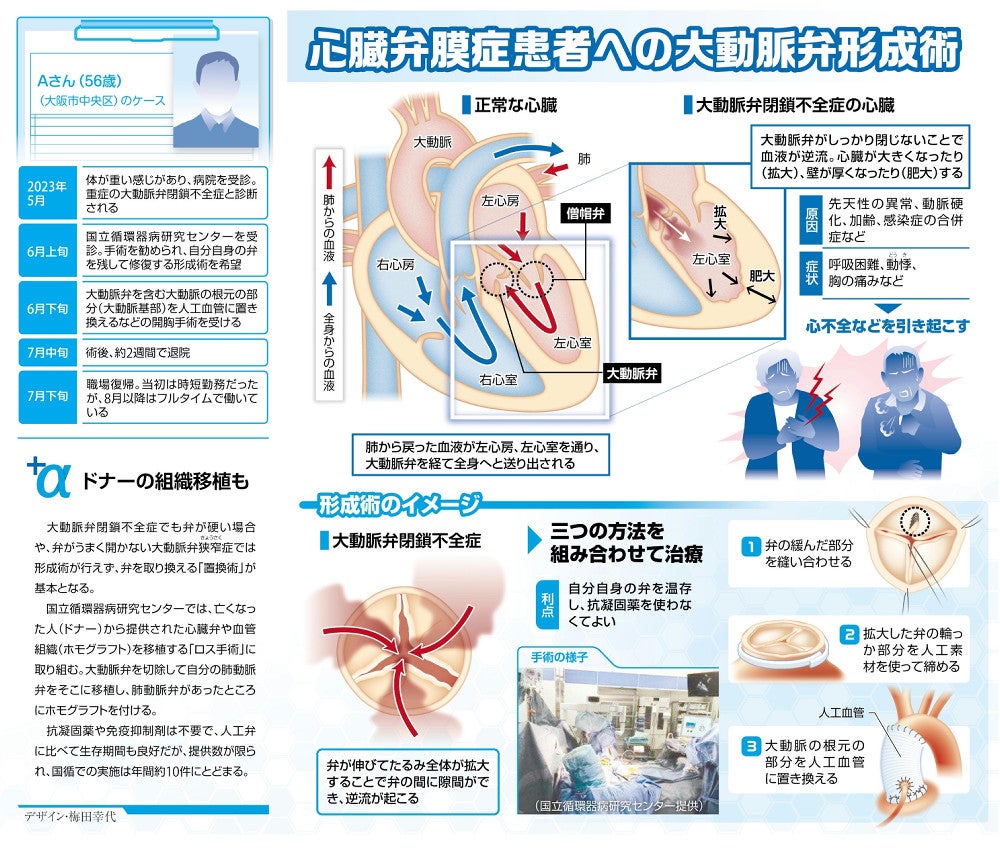 心臓弁膜症患者への大動脈弁形成術：地域ニュース : 読売新聞