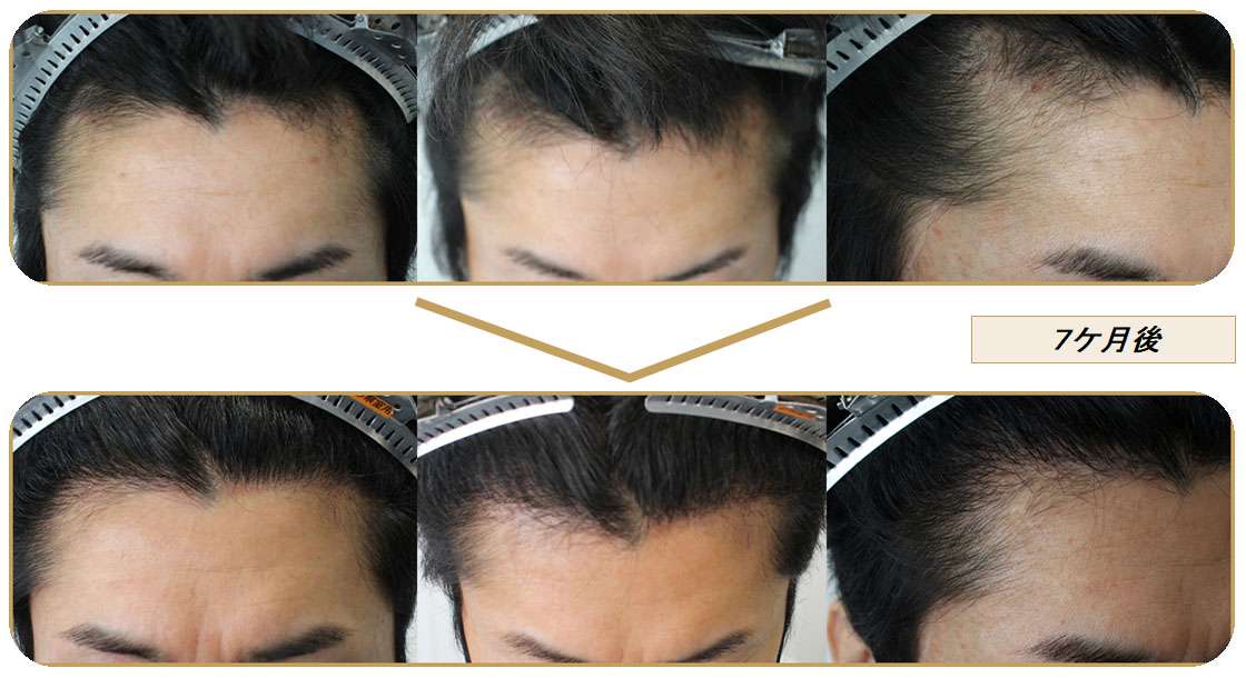 植毛術・参考症例集・FUE｜大阪梅田の自毛植毛・Dr Yamamoto hair
