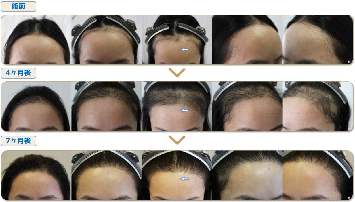 植毛術・参考症例集・FUT｜大阪梅田の自毛植毛・Dr Yamamoto hair
