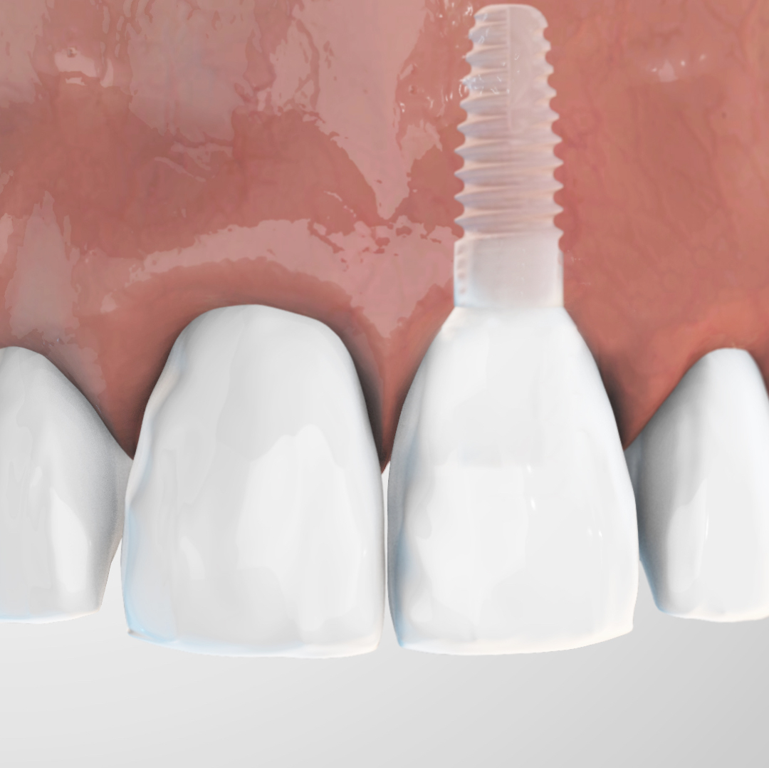 Zirconia implant system Zeramex XT - USA – ZERAMEX CeramTec
