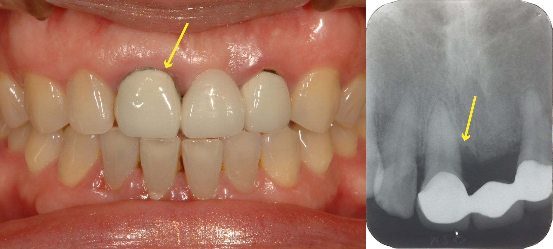 歯周組織再生療法（エムドゲイン）の症例｜天王寺区（四天王寺前夕陽ヶ