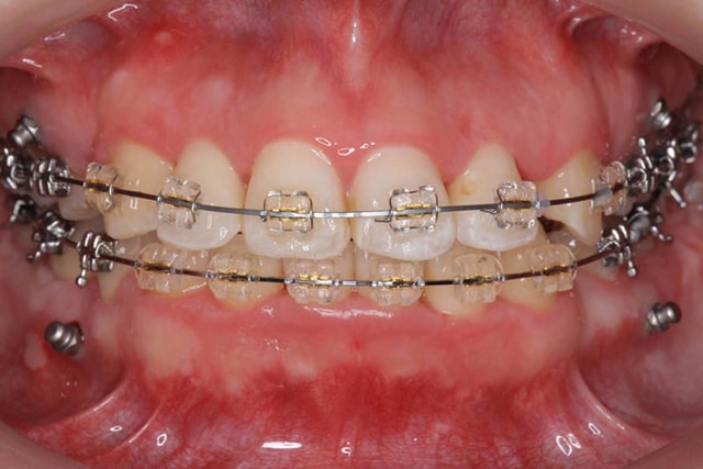 矯正歯科治療 | 横浜桜木町歯科