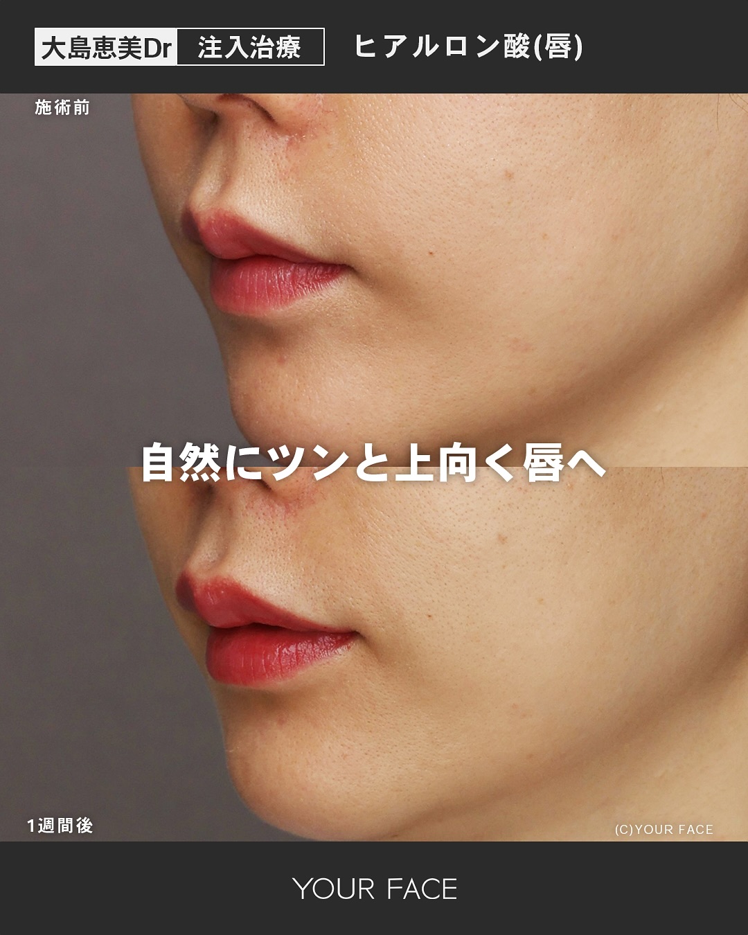 ヒアルロン酸 – YOUR FACE
