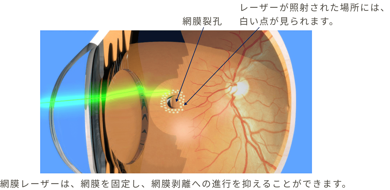 網膜剝離の前兆は？｜見逃しやすい初期症状と3つの治療法｜横浜・きく