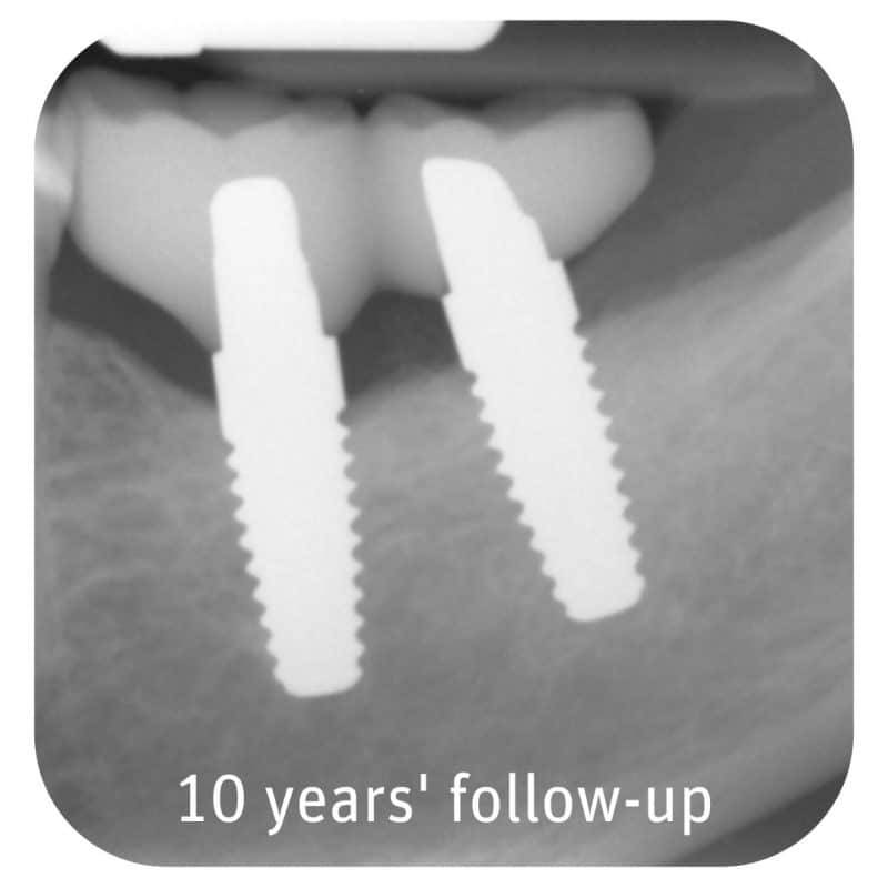 A Decade of Success: Zeramex Ceramic Implant Delivers Stable