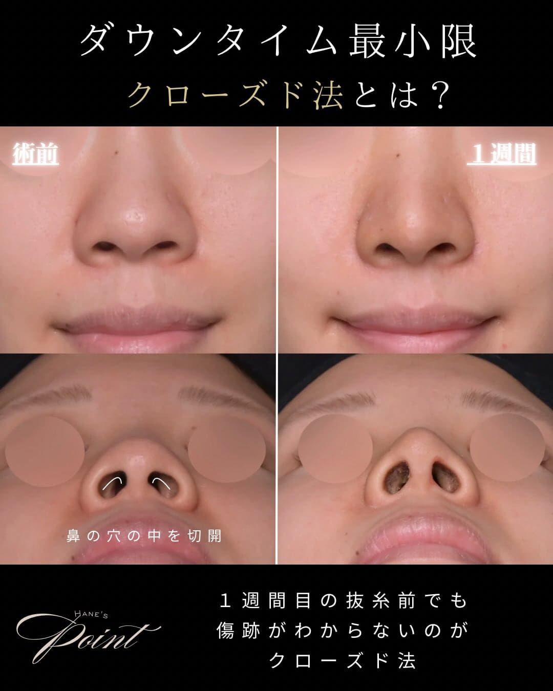 鼻整形 - ゼティスビューティークリニック｜鼻整形・鼻形成、美肌専門