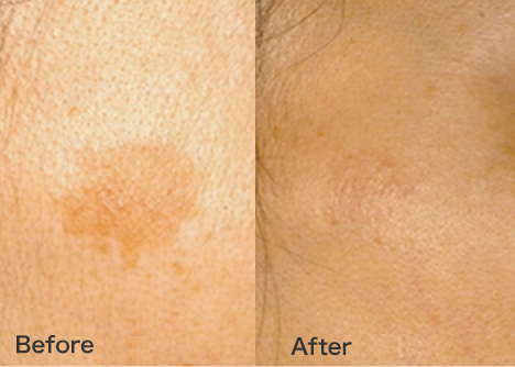 美肌・シミ・くすみ | 美顔レーザ－ | 顔・体のシミ取り | ピコ