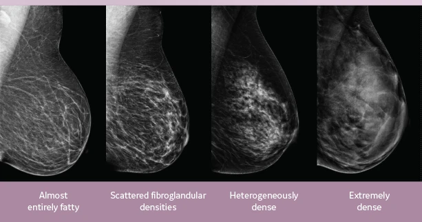 Abbreviated Breast MRI | Intermountain Medical Imaging