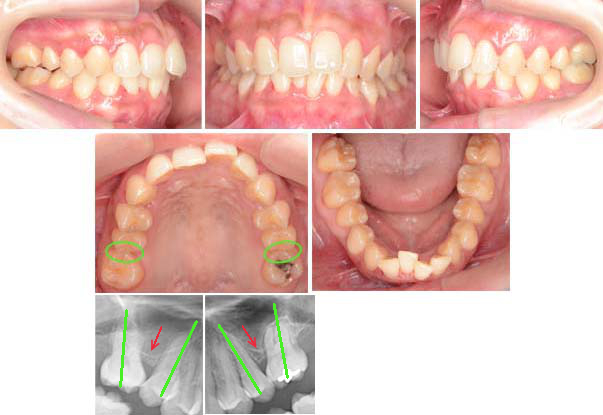 治療例No.169 第一大臼歯の欠如 上顎前突 過蓋咬合｜舌側矯正のアイ