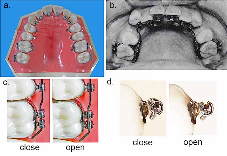 リンガルブラケットの真実と歴史（フジタメソッド）：裏側矯正の発展と