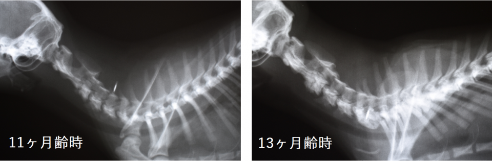 尾側頸椎‐胸椎の先天性奇形による脊椎不安定症を伴う脊柱管狭窄症のM