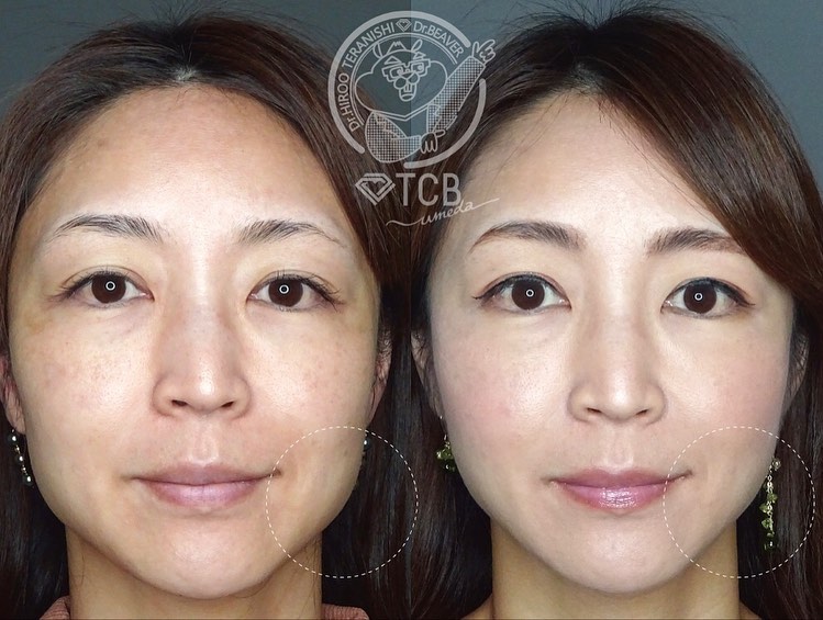 医療ハイフ（HIFU） | リフトアップはTCB東京中央美容外科