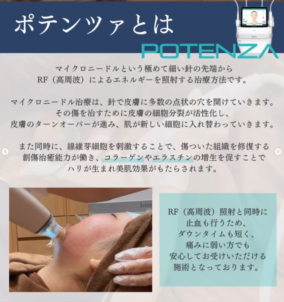 スタッフブログ】Q:40代でもポテンツァしていいの？美容看護師が質問に