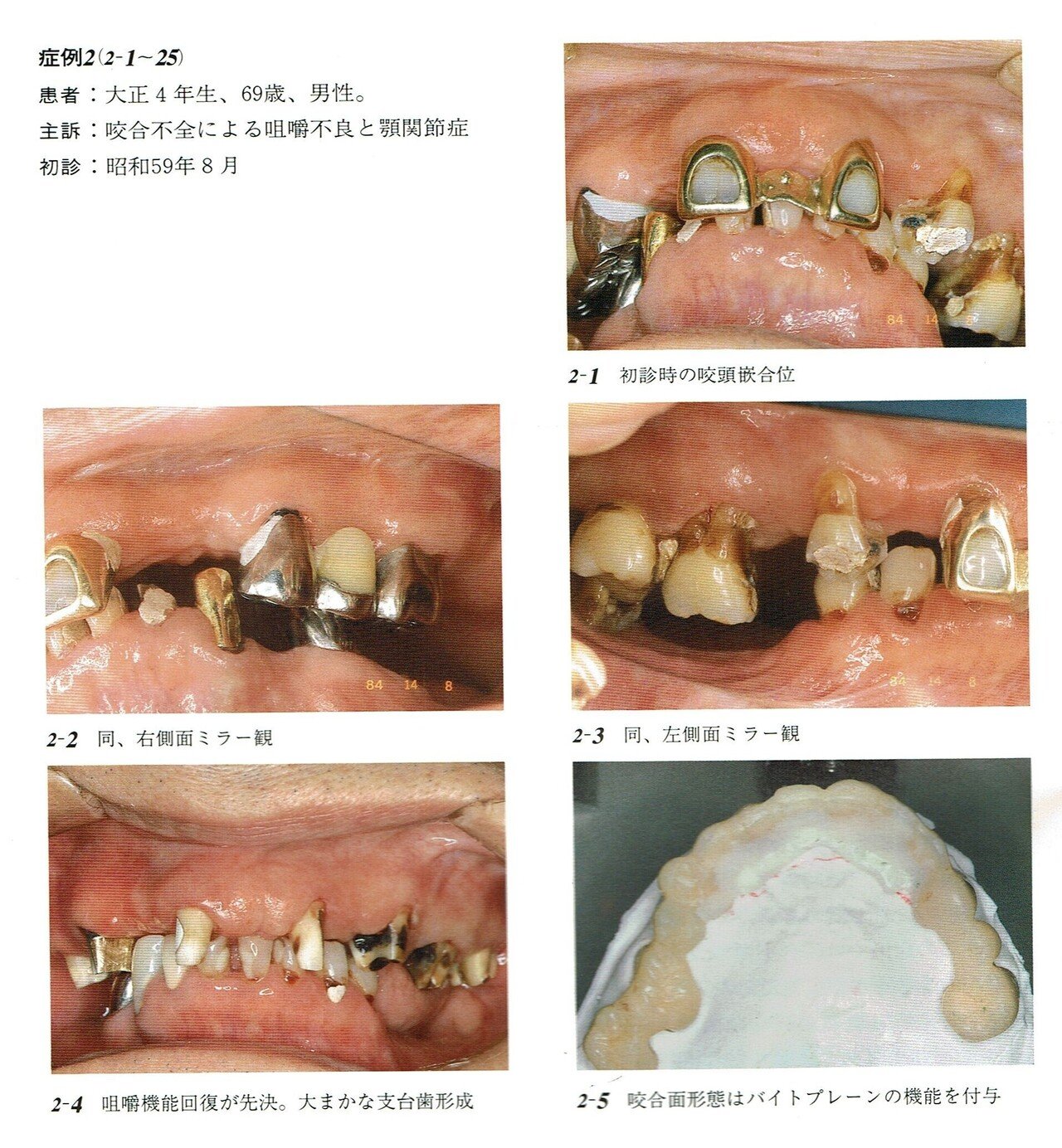 図解・咬合採得 図解・咬合採得 7 咬合採得①／垂直的顎