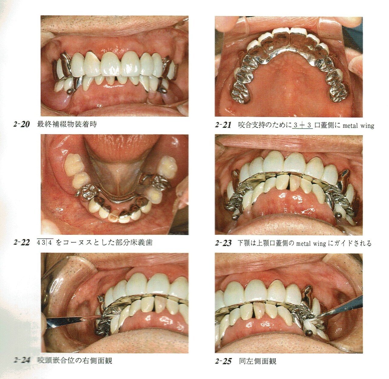 咬合再構成における治療用義歯（装置）の意義について｜東邦歯科診療所