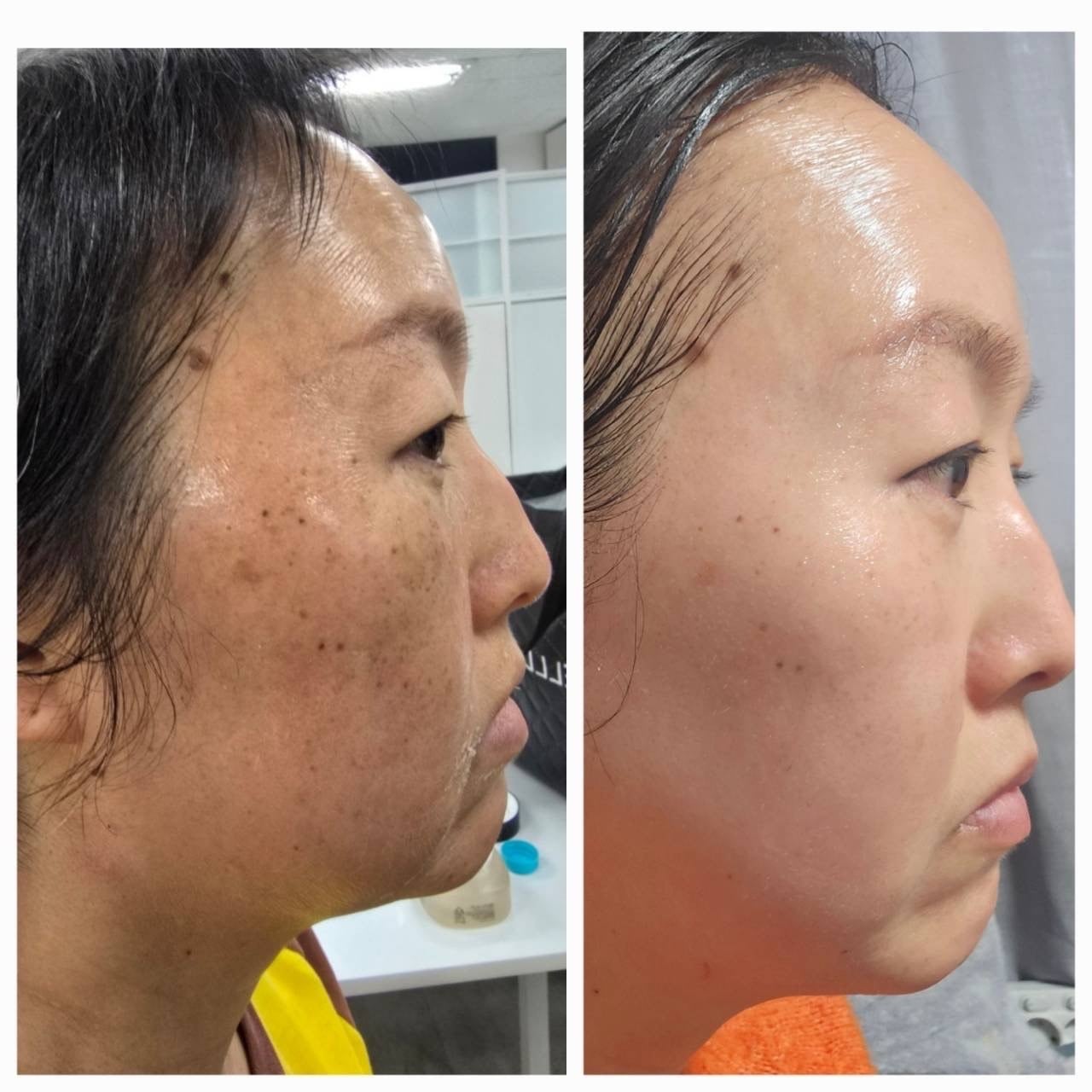 インセルダム症例写真 | incellderm-ICD-整形級コスメインセルダム