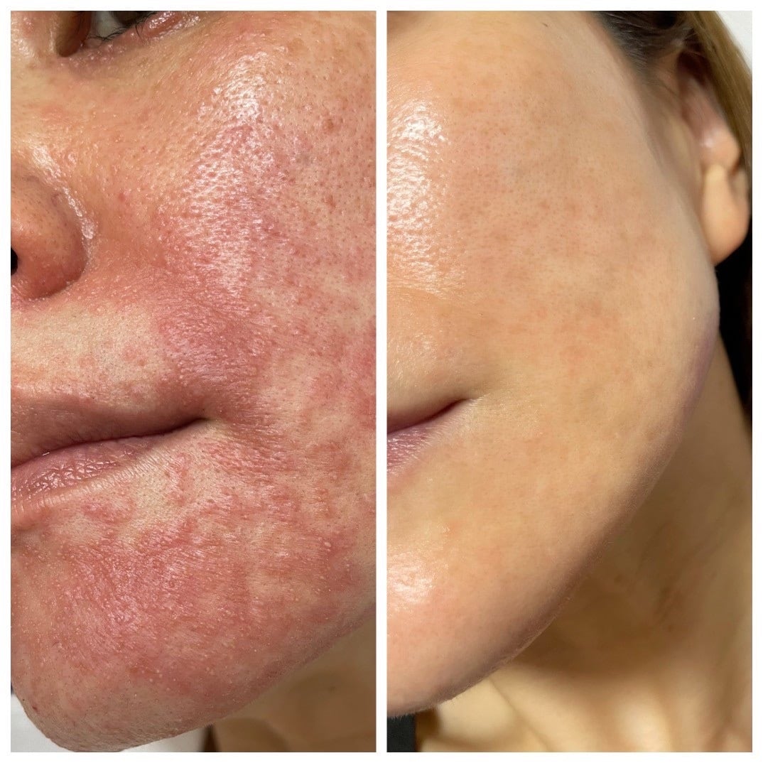 アズイリス 炭酸ガスパック | Pay ID