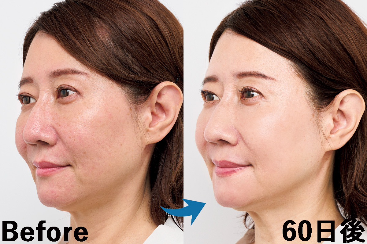 赤みやくすみが消えた…YA-MANの「フェイスマスク型美顔器」を60日間