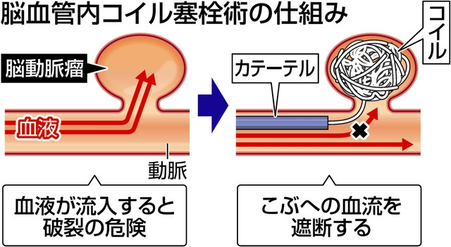 希少なプラチナ製コイル、無駄にしない 脳手術の現場にもSDGs