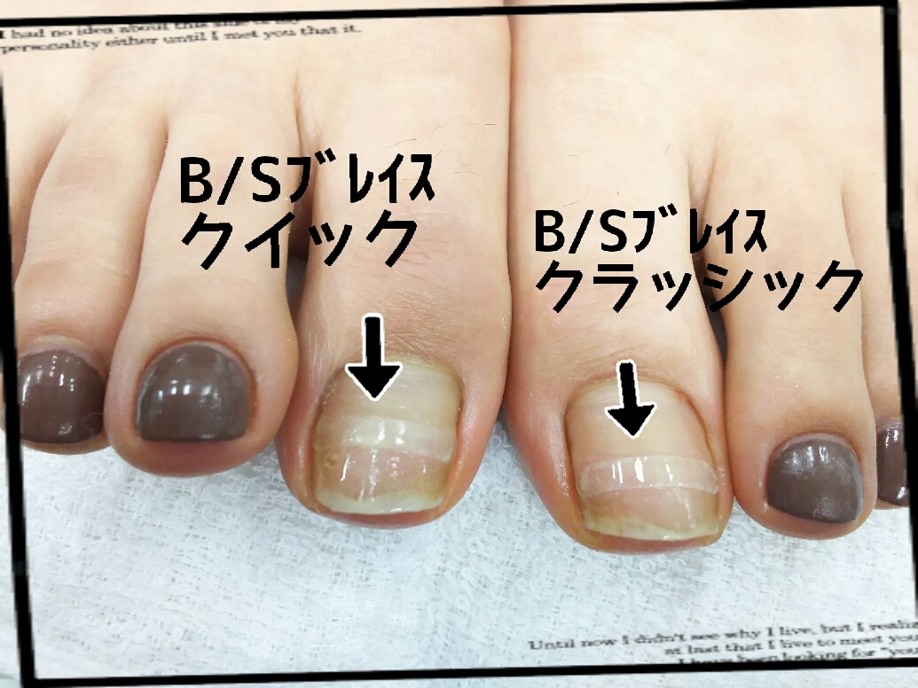 B/Sブレイスセミナー（巻き爪改善セミナー） | AR'-ビューティーサロン