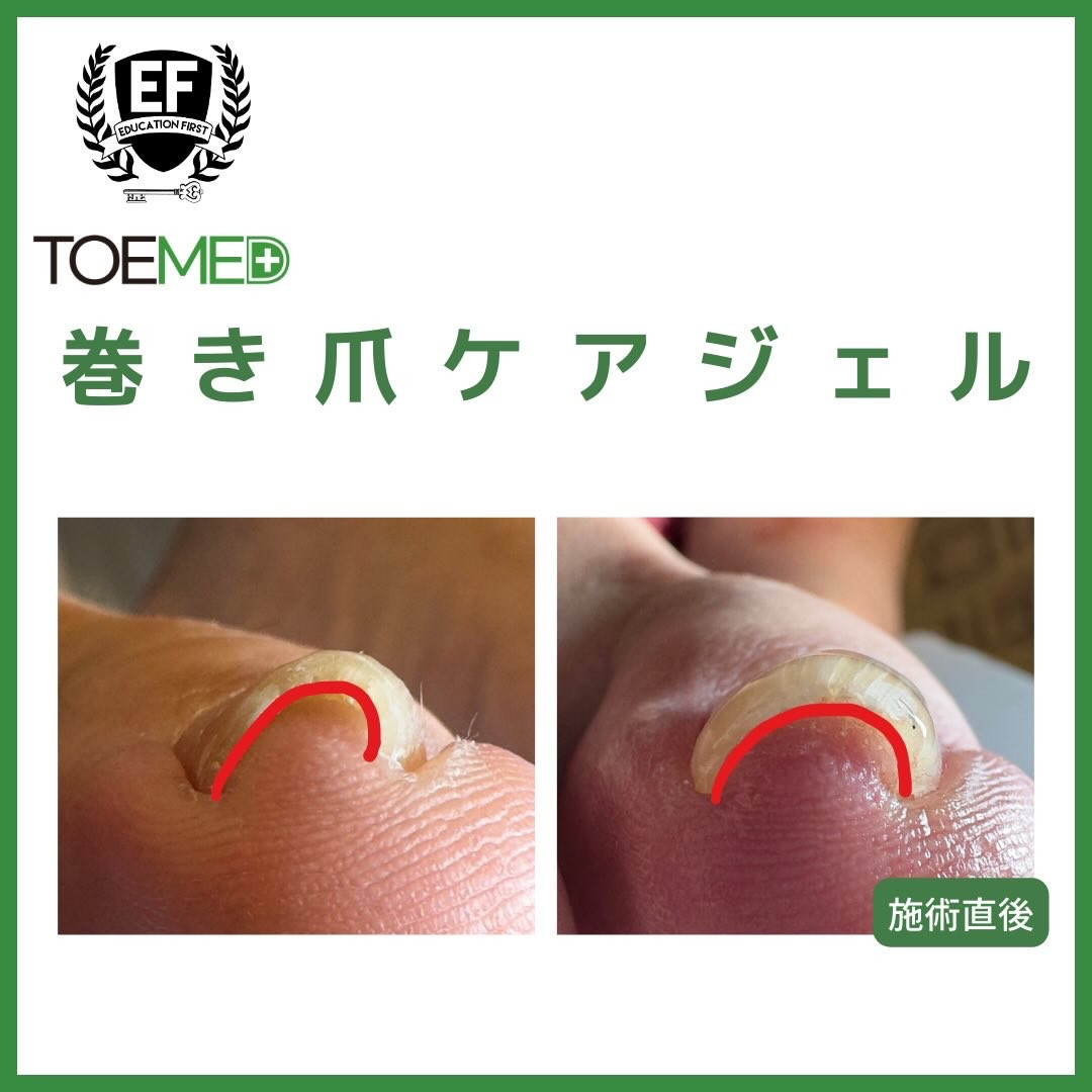 TOEMED 巻き爪ケアジェル 韓国発の革新的巻き爪ケアジェル「TOEMED」登場！美しい足元へ導く