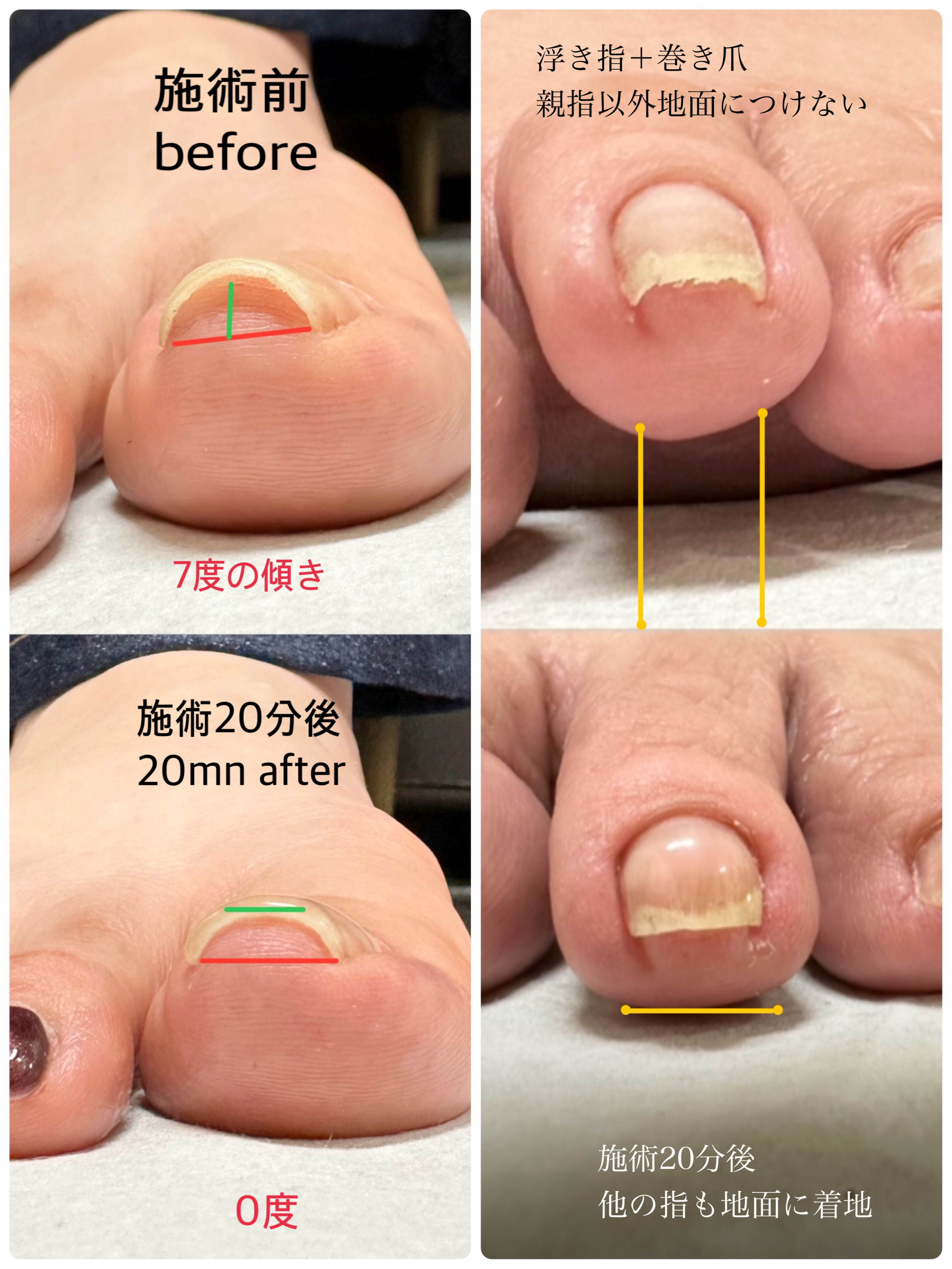 TOEMED 巻き爪ケア 3点セット 塗るだけで巻き爪ケア出来るジェルTOEMED‼️ | nail ＆ foot care