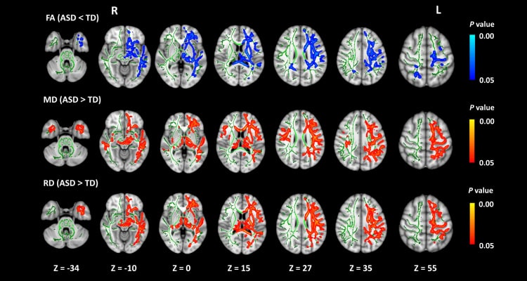Researchers from Japan find how alterations in brain connectivity