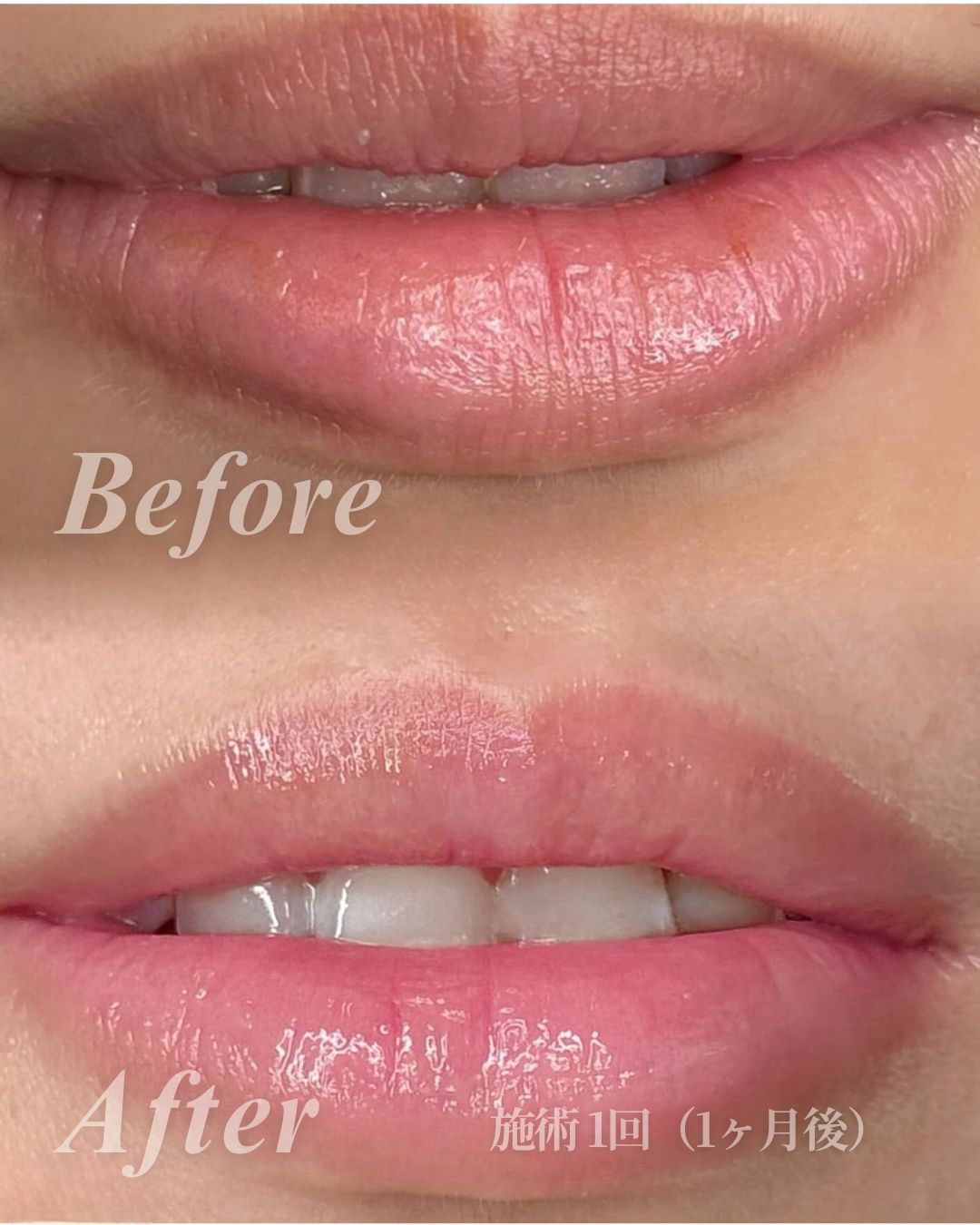 ローマピンク｜唇・デリケートゾーンの黒ずみ改善ならローマピンク公式