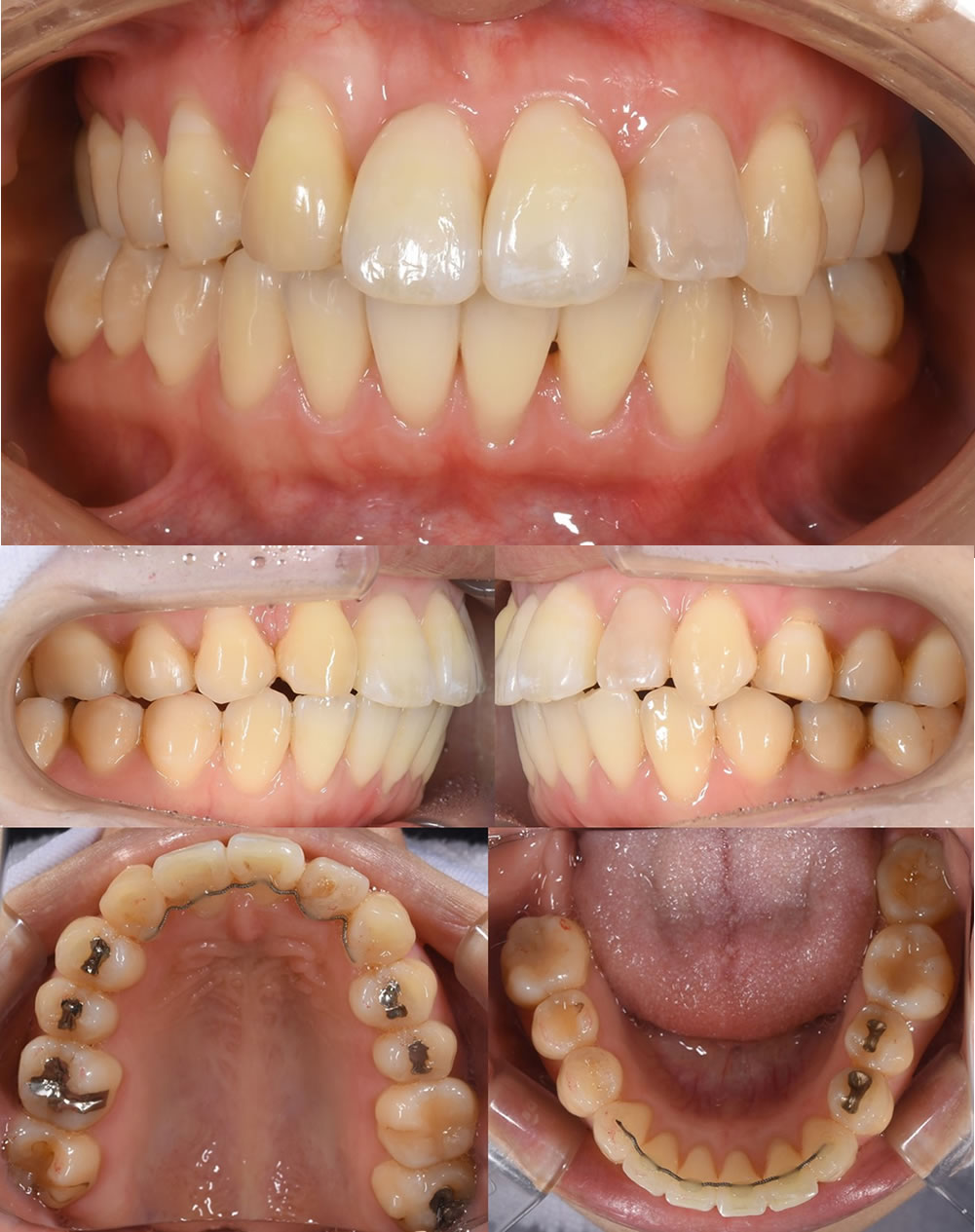 世田谷区の矯正歯科｜マウスピース矯正・部分矯正｜千歳船橋歯科