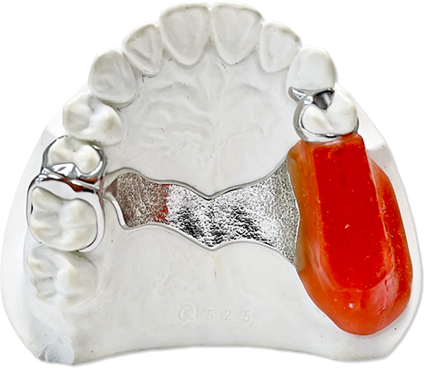 歯科技工物/デンチャー | 歯科技工所 コットンテール