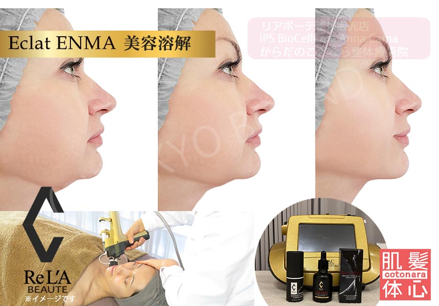 予約受付中】リアボーテ 美容溶解トリートメント〈シャープな輪郭