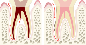 エンドペリオ｜clara dental clinic｜北九州市小倉北区の歯医者