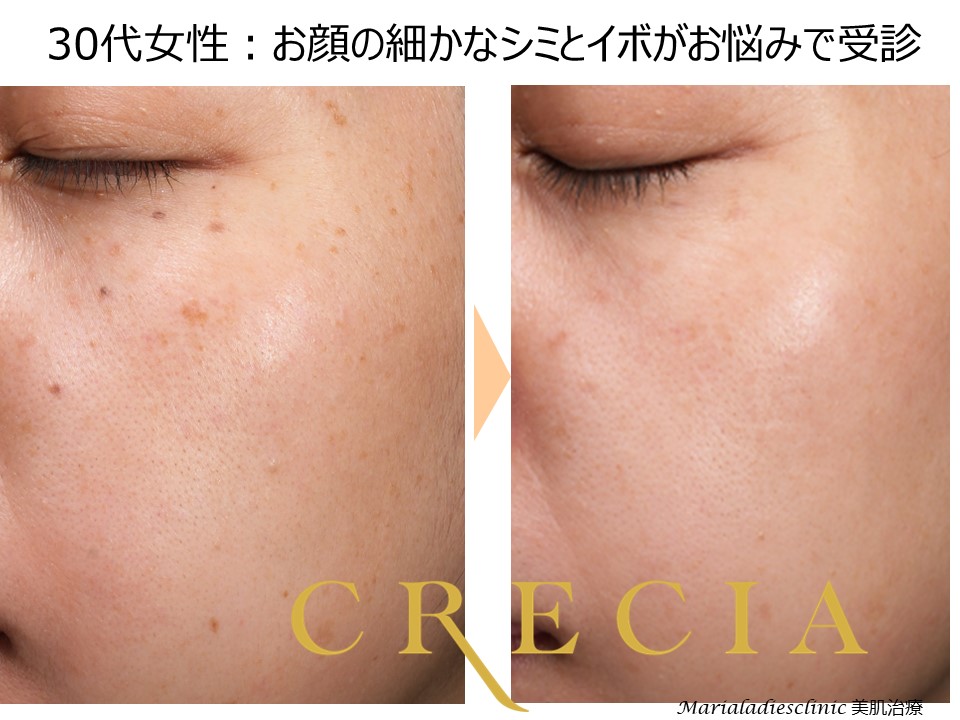 美肌カスタマイズ治療とは？ | 葛飾区の美容皮膚科：クレシア