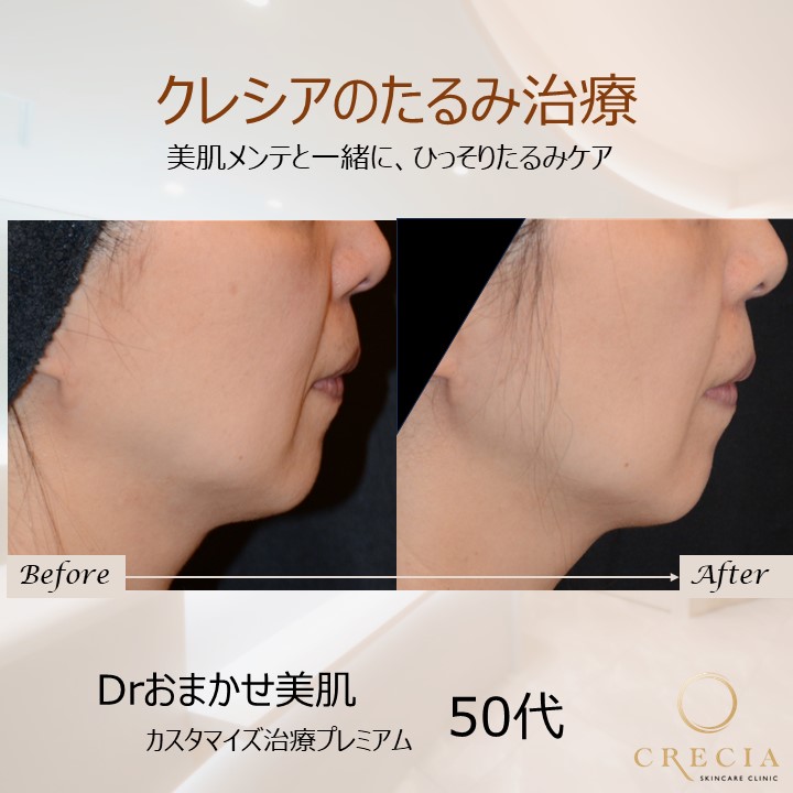 ハイフ・医療ハイフ（HIFU） | 葛飾区の美容皮膚科：クレシア