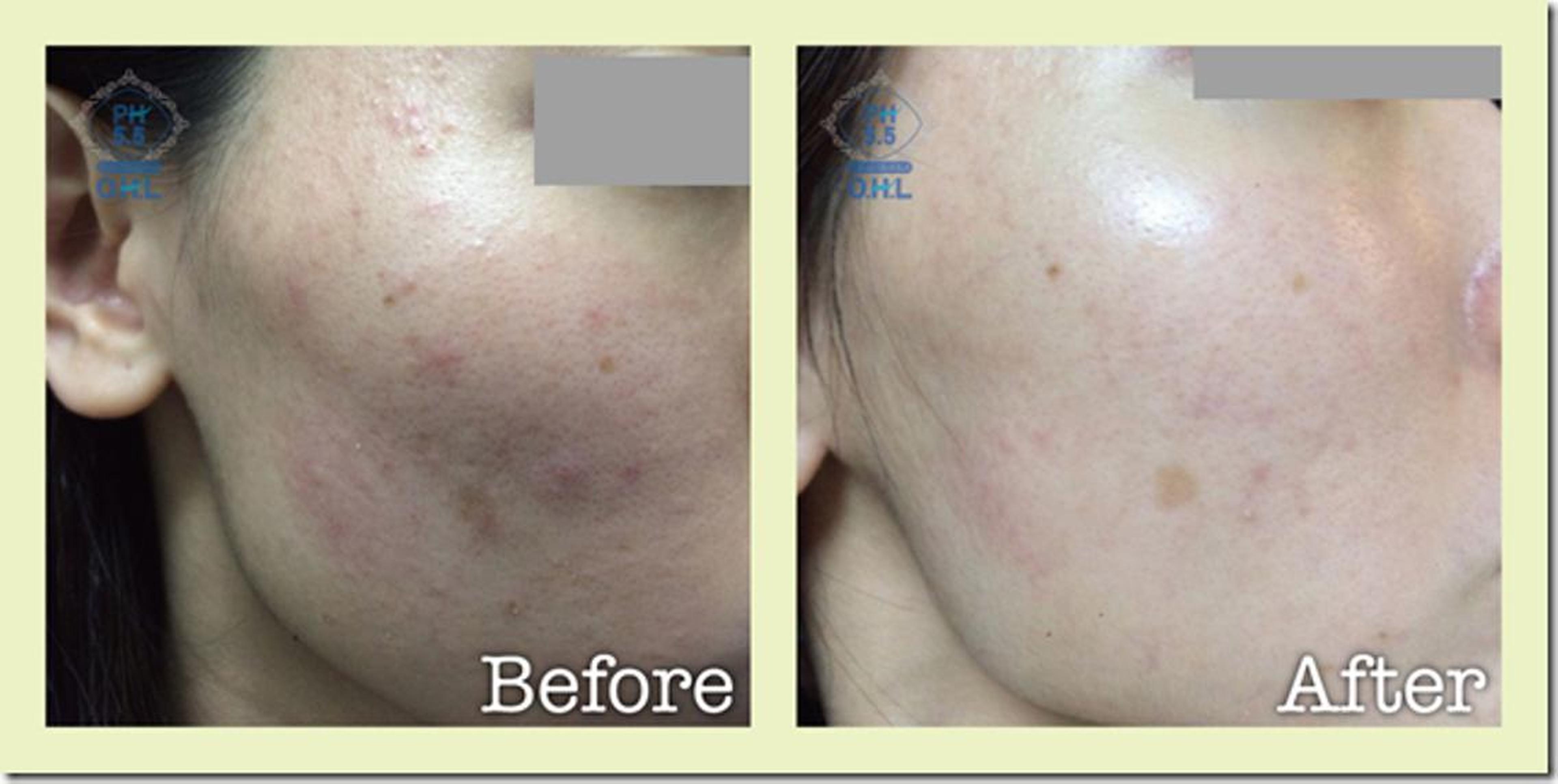 剥離無しハーブピーリング 回数が必要になります 最低5回〜6回は続け