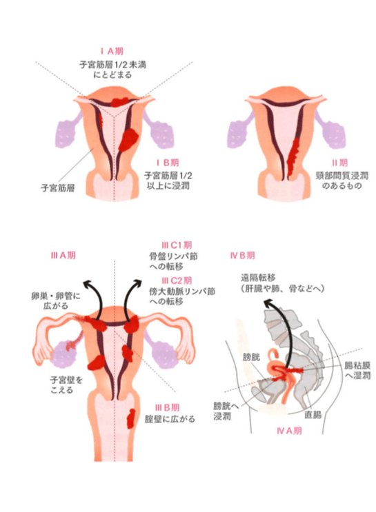 子宮体がん | さまざまながんの診断と治療 | がんとともに生きる