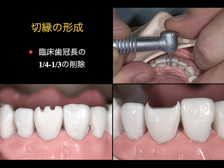 速く・上手に！誰でもできる支台歯形成テクニック | 株式会社 医療情報