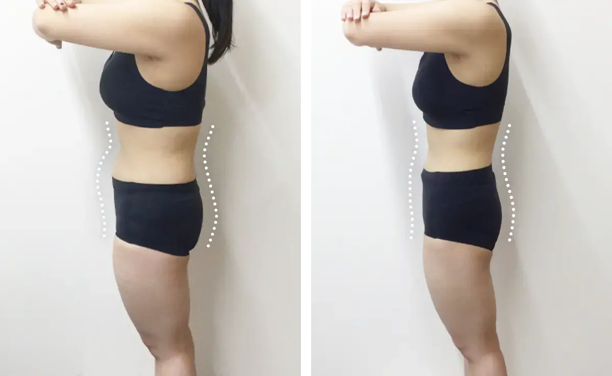 医療ダイエット症例:3カ月で61.6kg→52.8kg（158cm・20代女性）｜エミ