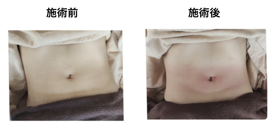 業務用痩身機セルブレイカー EXとは？特徴やマシン価格、効果などを