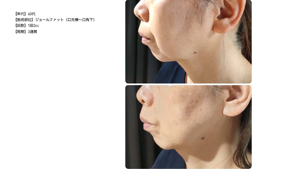 レモンボトル（10ml×5本）×5個セット 脂肪分解／脂肪溶解剤 - エステの