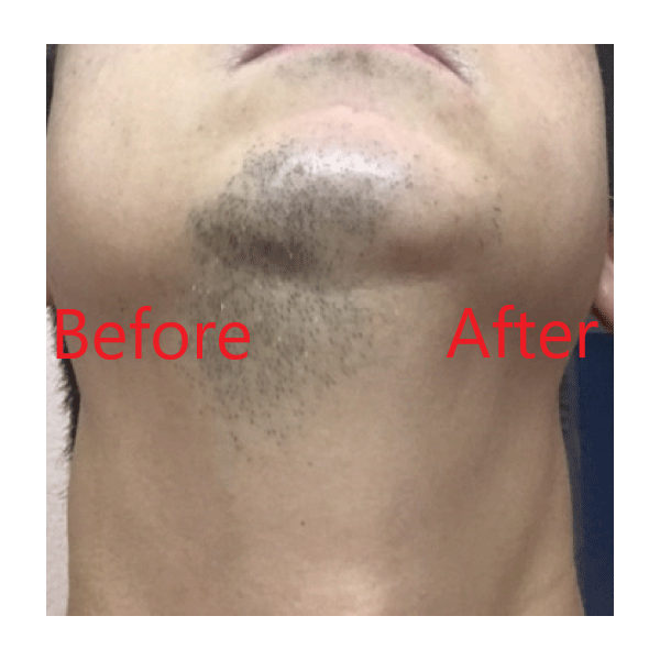 業務用脱毛機アクア(AQUA) | エステ機器のワールドジャパンワールド