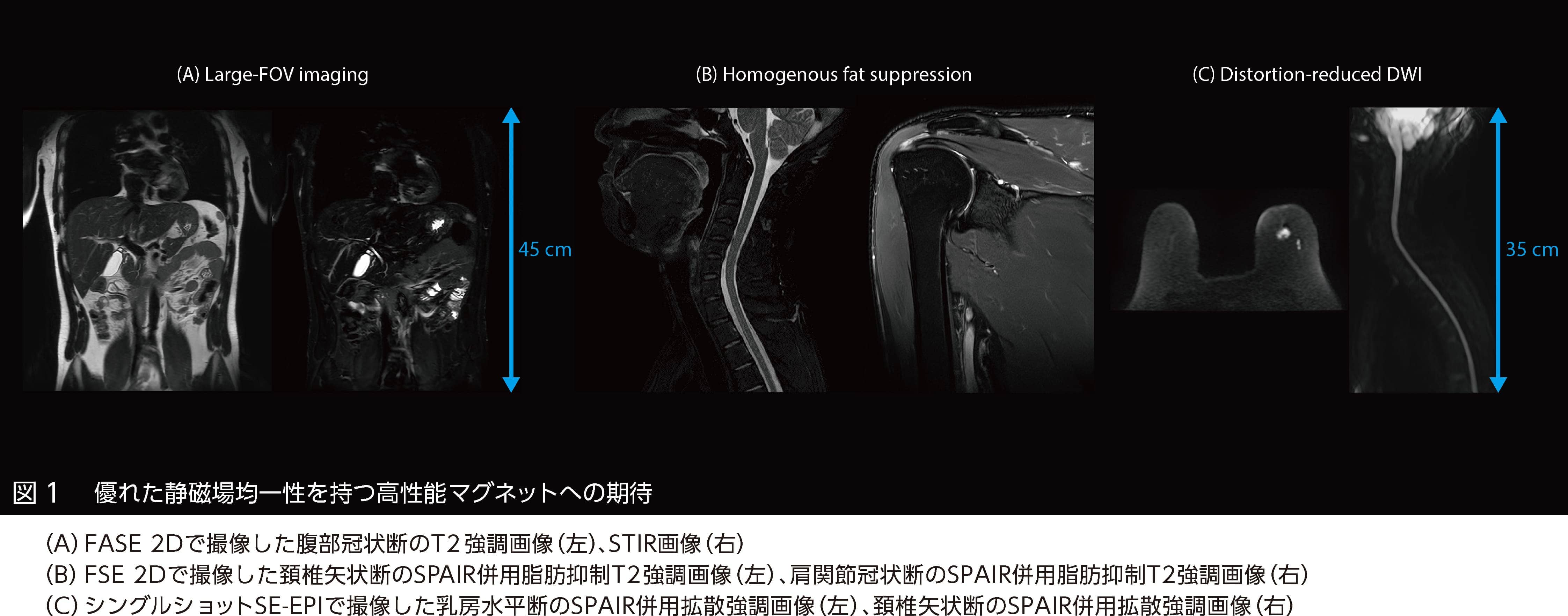 Vantage Galan 3T / Supreme Editionは3T MRIの新境地を切り拓くのか