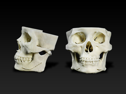 3次元実体模型（高精度） | 医療機器 | Dr.ヒロヒの顔面骨形成術