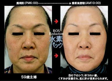 ROS Reduction-ロスリダクション-】H2パック | 業務用美容・エステ機器