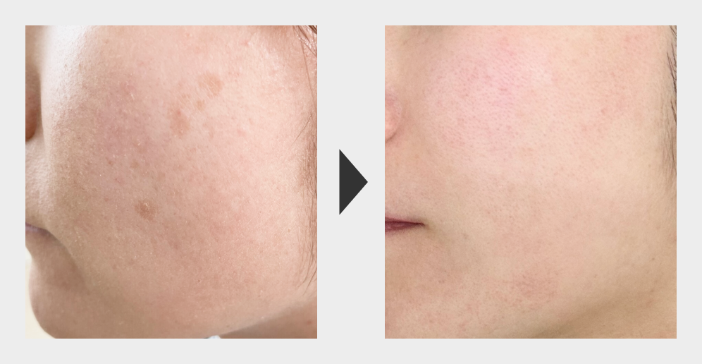 シミ取りレーザー（東京浜松町院） - 東京の美容皮膚科ならFLALU（フラ