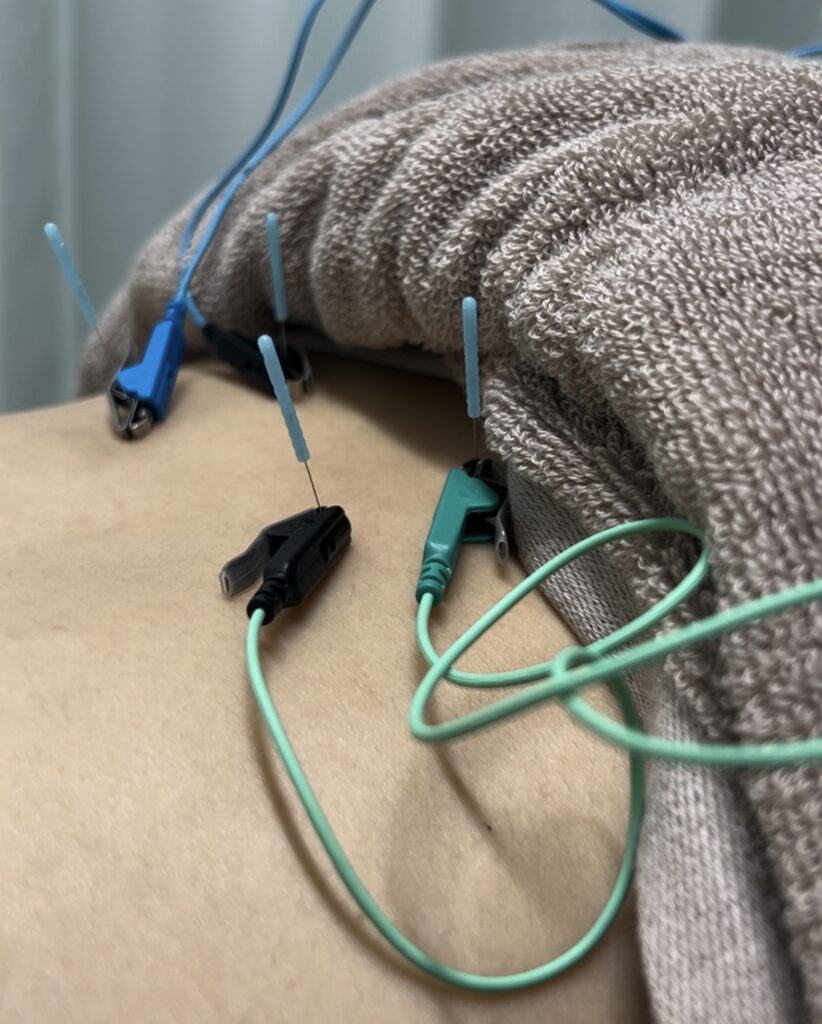 鍼治療 —東広島市 鍼灸院フロンティア－ | 鍼灸院フロンティア