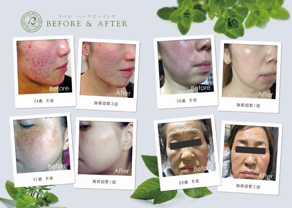 リベルハーブピーリング - フランジスパ